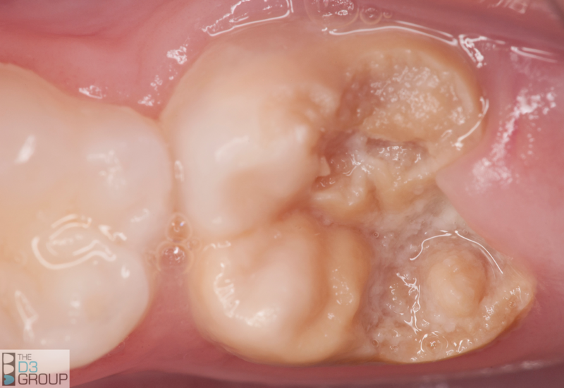 Chalky Teeth | A Gallery from Nine To Noon | RNZ National