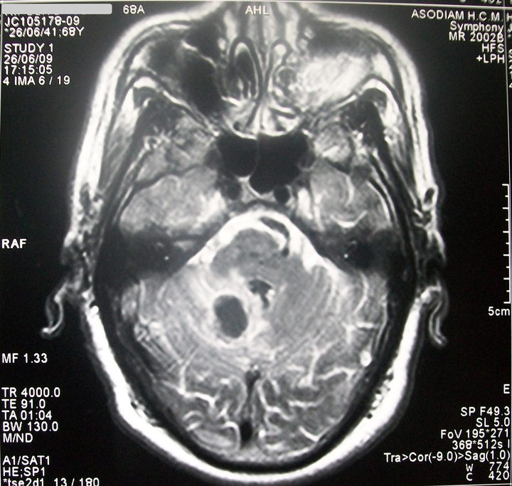 Stroke in MRI 