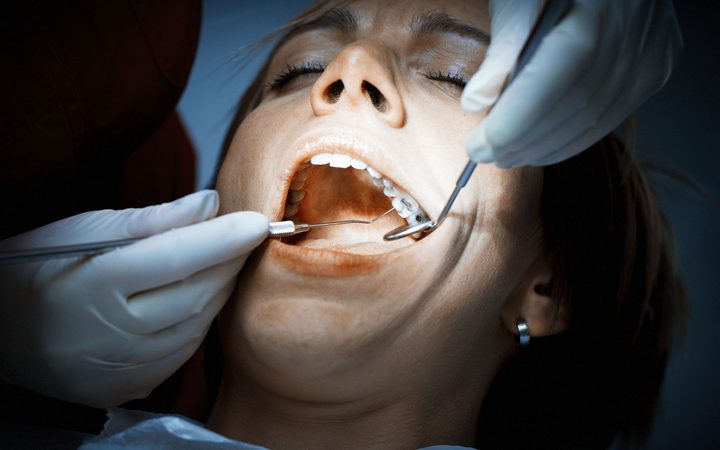 The Dangers of Amalgam Fillings ile ilgili görsel sonucu