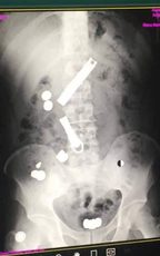 An x-ray showing the metal objects swallowed by a refugee.