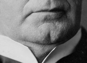 A fine example of a cleft chin, sported by US President William McKinley 