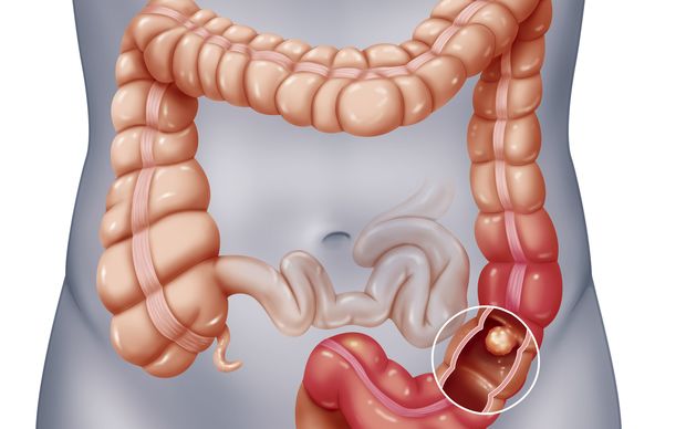 Illustration of bowel cancer.