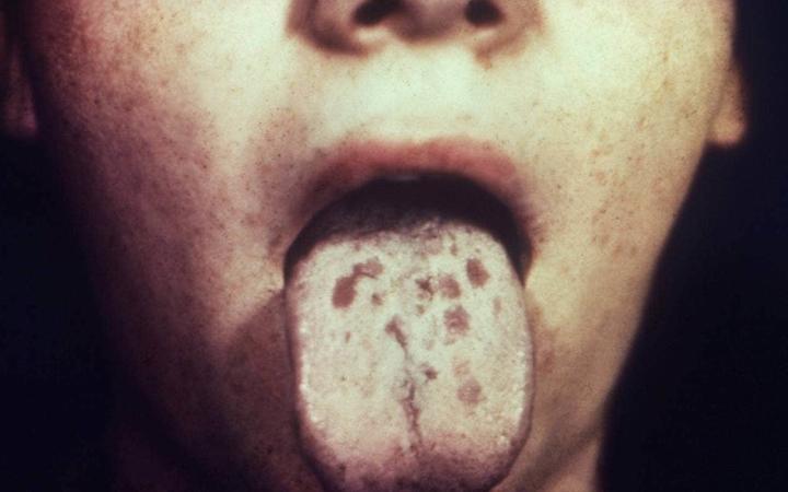 An historic photo from the US of a patient's ankle with coin shaped lesions caused by secondary syphilis.