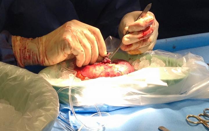 The kidney that Rachel Rouge donated. AKA " Bert"