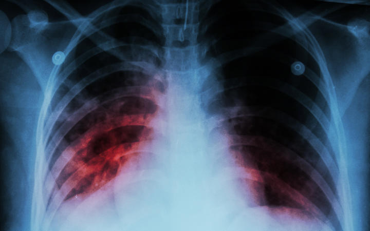 Pulmonary Tuberculosis ( TB )  :  Chest x-ray show alveolar infiltration at both lung due to mycobacterium tuberculosis infection