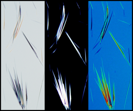 Gout crystals