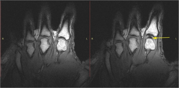 Fig T static images of the hand in the resting phase before cracking left
