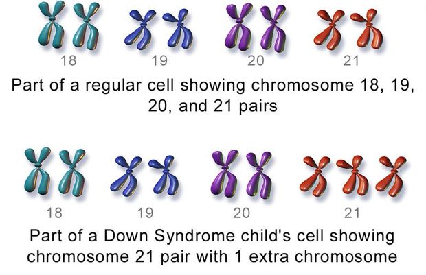 Down Syndrome CC BY Blausen