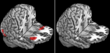 The bilateral anterior insula.